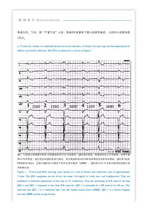 【中英双语 _ 心电图教学】高度房室传导阻滞1例