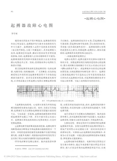 起搏器故障心电图李学斌