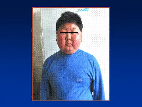 皮质醇增多症 精品