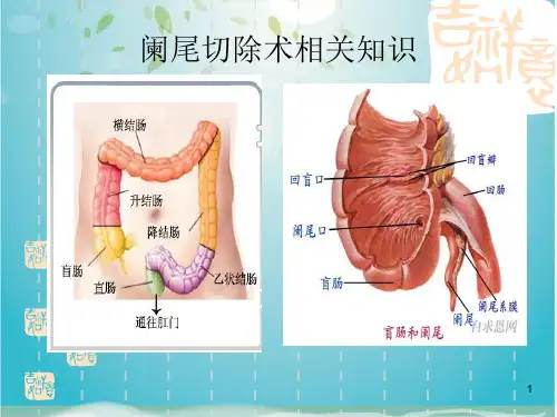 阑尾切除术相关知识及手术步骤