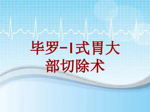 手术讲解模板：毕罗-I式胃大部切除术