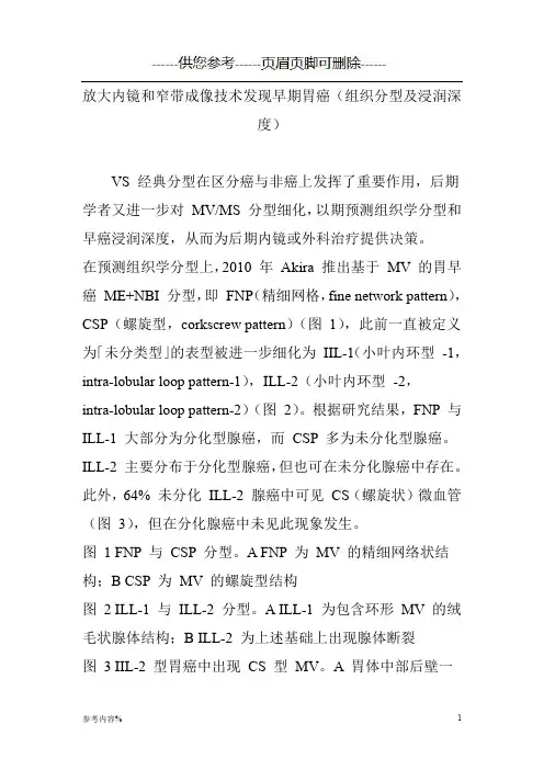 放大内镜和窄带成像技术发现早期胃癌(组织分型及浸润深度)(参考提供)
