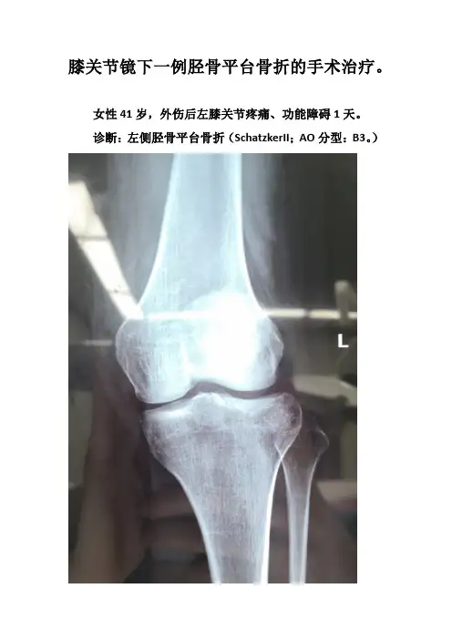 胫骨平台塌陷手术