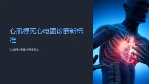 心肌梗死心电图诊断新标准(诊断标准演变)