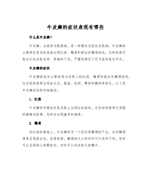 牛皮癣的症状表现有哪些