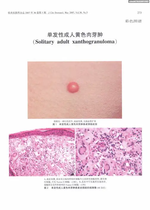 单发性成人黄色肉芽肿
