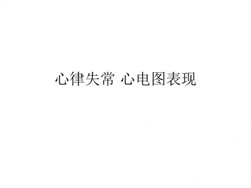 心律失常心电图