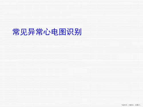 常见异常心电图识别