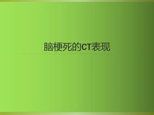 脑梗死CT影像