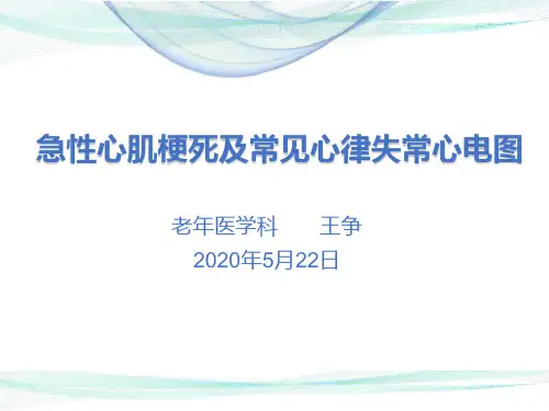 急性心肌梗死及常见心律失常的心电图诊断