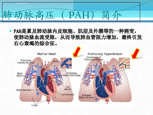 肺动脉高压查房ppt课件