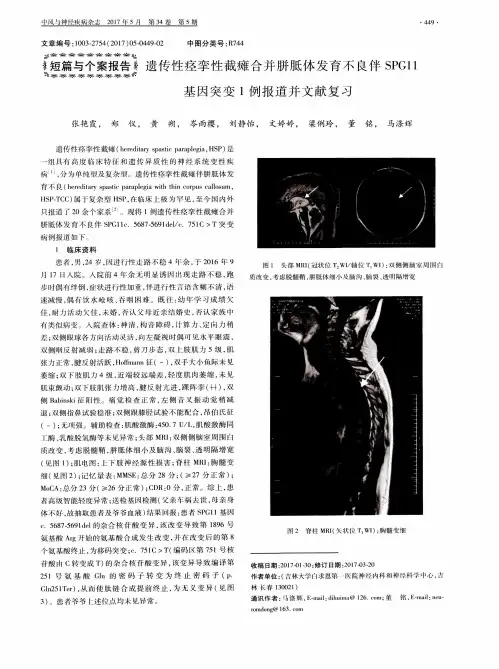 遗传性痉挛性截瘫合并胼胝体发育不良伴SPG11基因突变1例报道并文献复习