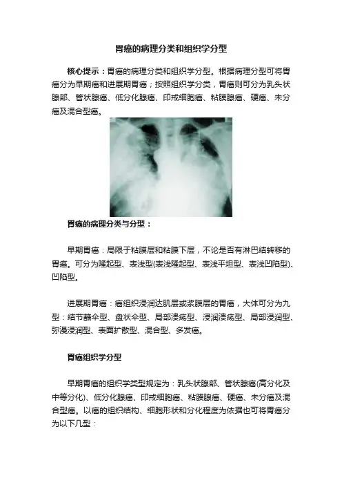 胃癌的病理分类和组织学分型