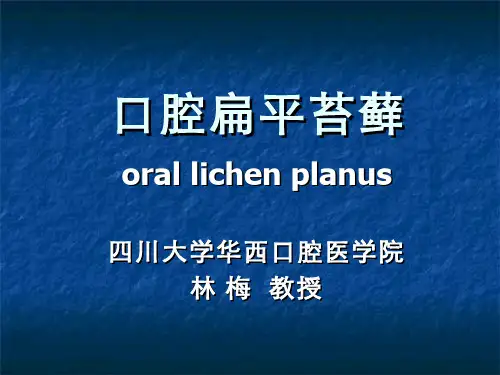 口腔扁平苔藓特点及治疗