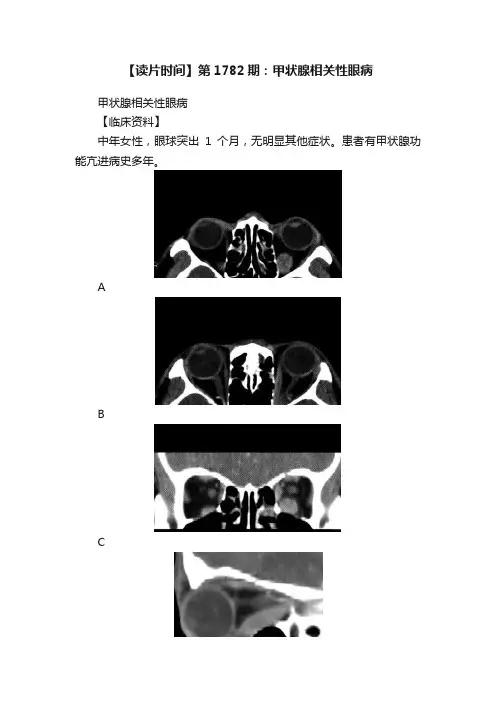 【读片时间】第1782期：甲状腺相关性眼病