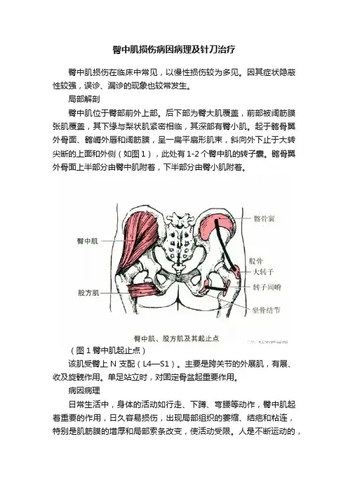 臀中肌损伤病因病理及针刀治疗