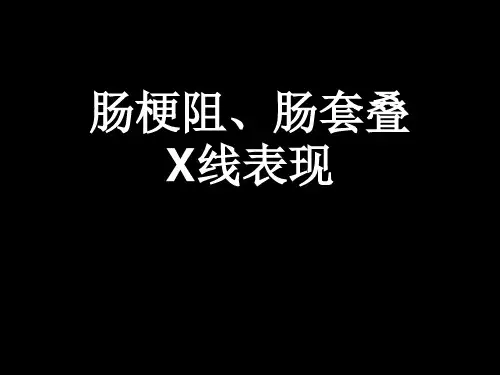 肠梗阻肠套叠X线表现医学影像学精品PPT课件