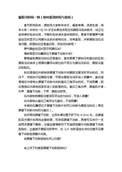 腹股沟斜疝一例（如何鉴别斜疝与直疝）