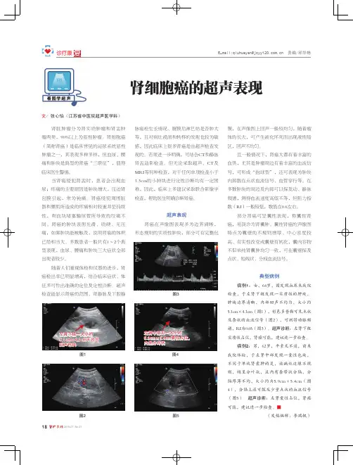 肾细胞癌的超声表现