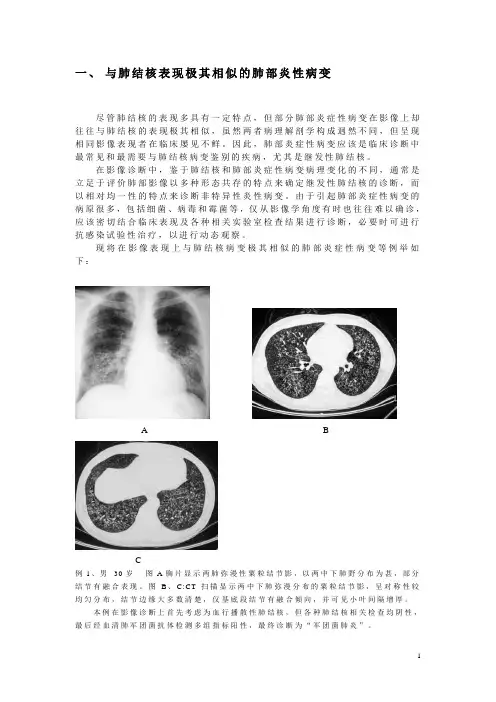 肺结核不典型影像学表现的分析与诊断