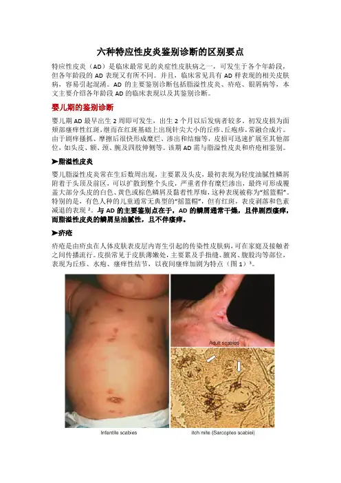六种特应性皮炎鉴别诊断的区别要点
