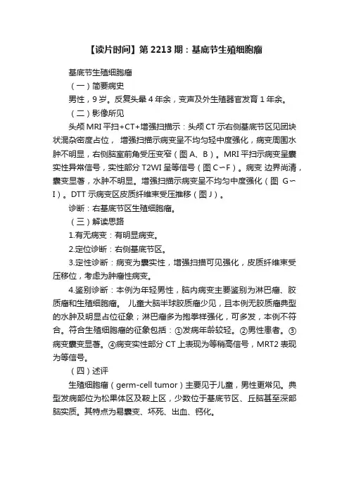 【读片时间】第2213期：基底节生殖细胞瘤