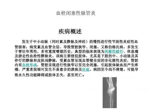 血栓闭塞性脉管炎