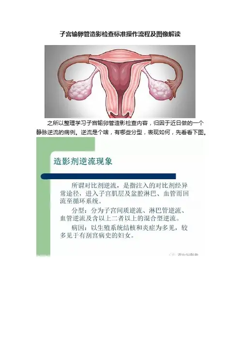子宫输卵管造影检查标准操作流程及图像解读