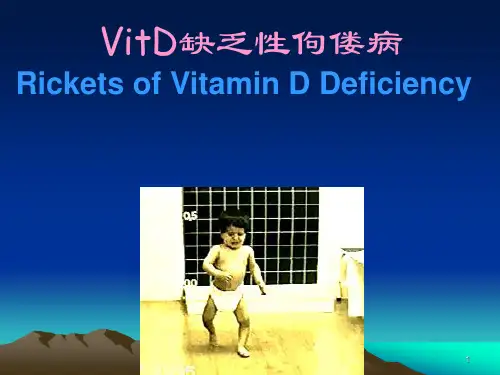 VitD缺乏性佝偻病ppt课件