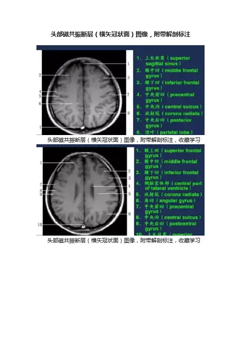 头部磁共振断层（横矢冠状面）图像，附带解剖标注