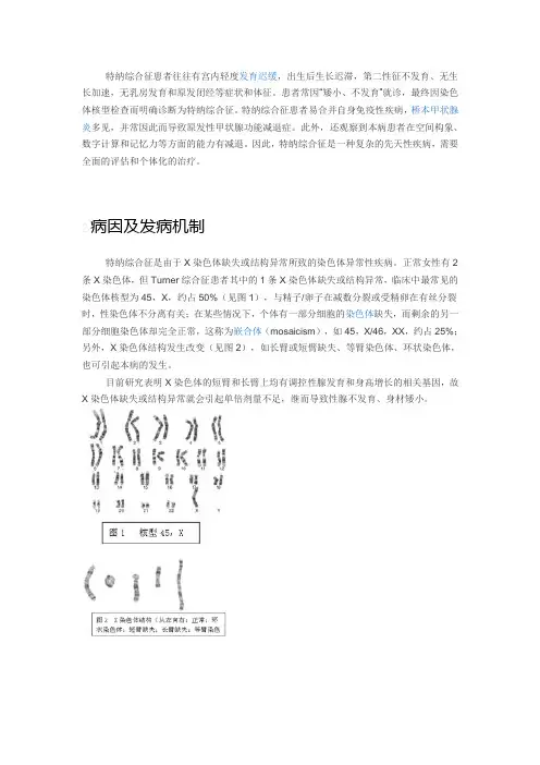 特纳综合征患者往往有宫内轻度发育迟缓