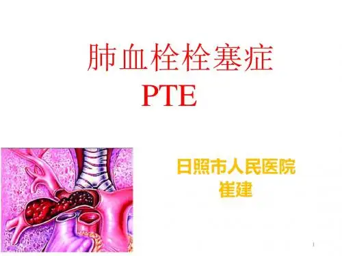 肺栓塞幻灯ppt课件