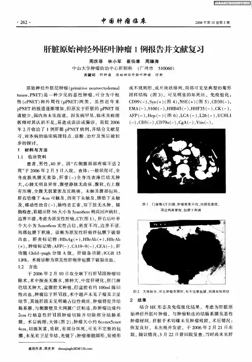 肝脏原始神经外胚叶肿瘤1例报告并文献复习