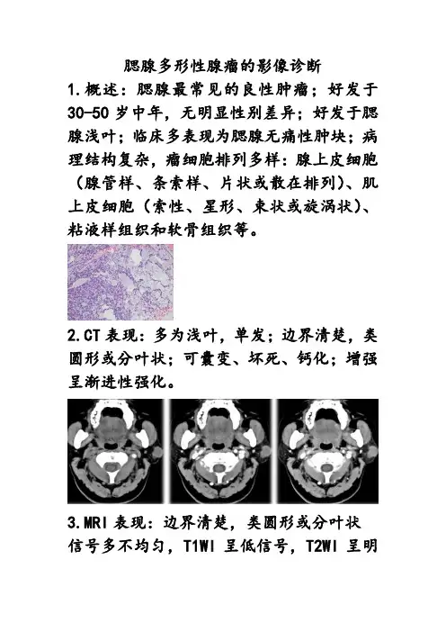 多形性腺瘤 影像诊断