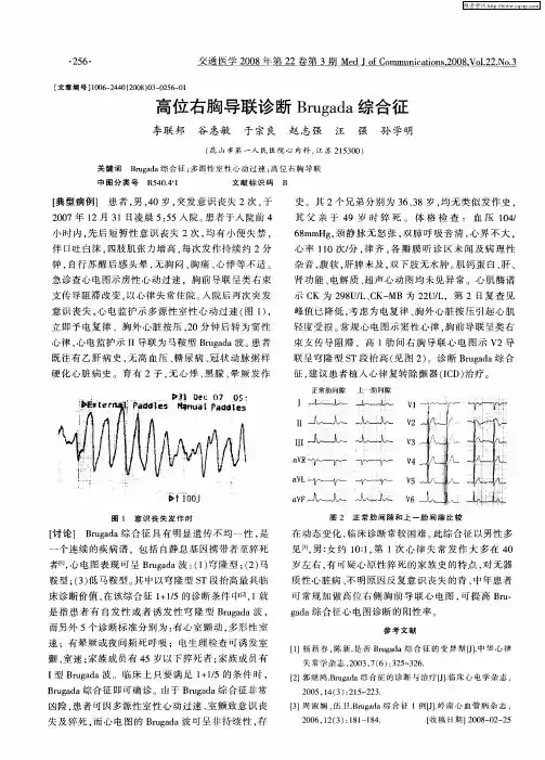 高位右胸导联诊断Brugada综合征