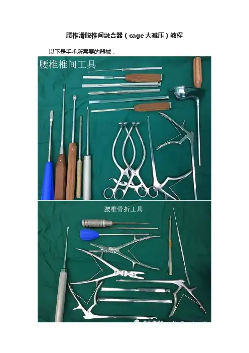 腰椎滑脱椎间融合器（cage大减压）教程