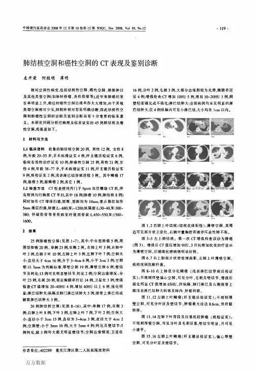 肺结核空洞和癌性空洞的CT表现及鉴别诊断