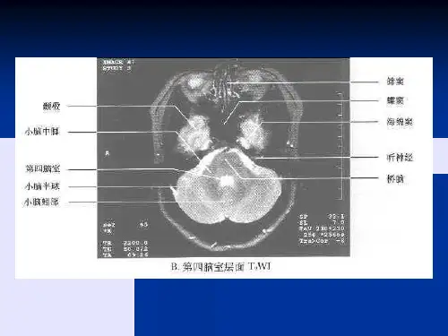 中枢神经系统常见肿瘤的MRI诊断-文档资料