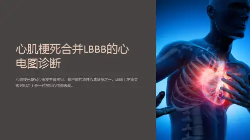 心肌梗死合并LBBB的心电图诊断