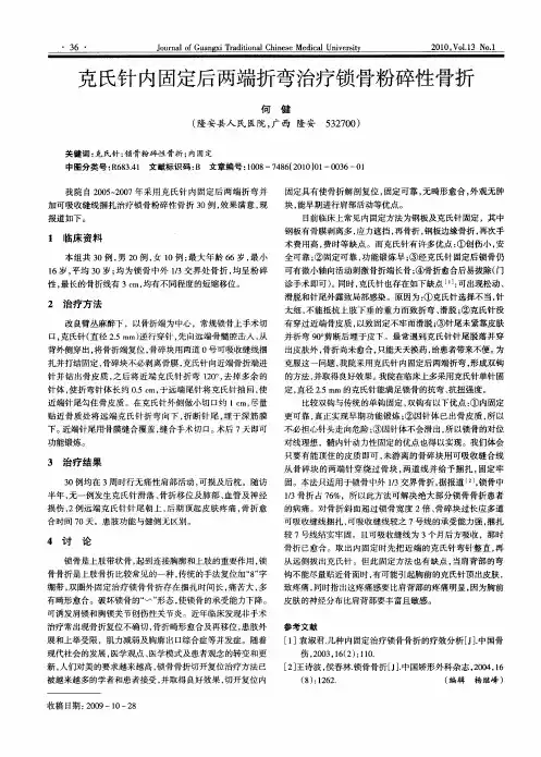 克氏针内固定后两端折弯治疗锁骨粉碎性骨折