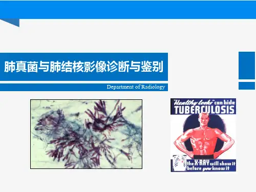 肺部真菌与结核诊断与鉴别诊断