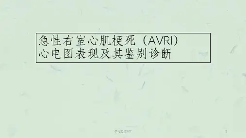急性右室心肌梗死(AVRI)心电图表现及其鉴别诊断课件
