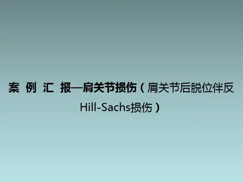 肩关节损伤(肩关节后脱位伴反Hill-Sachs损伤)完整版本