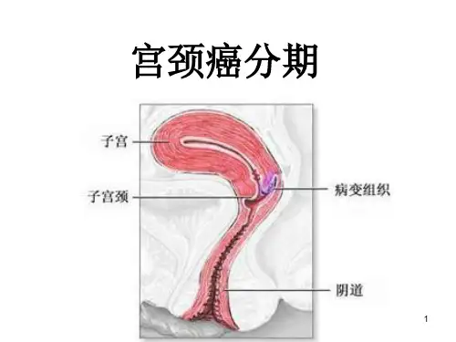 宫颈癌分期PPT课件