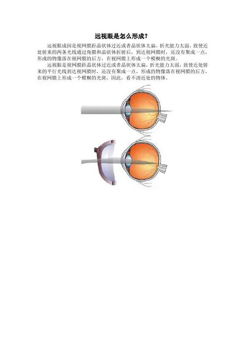 远视眼是怎么形成？