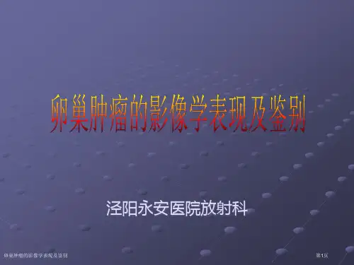 卵巢肿瘤的影像学表现及鉴别专家讲座